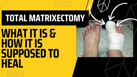 Recently had a total matrixectomy? Here's what to expect.. - YouTube