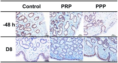 Representative Images Of Immunohistochemical PR Expression In Uterine