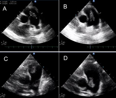 Isolated Pulmonary Valve Endocarditis A Case Report And Review Of Literature Journal Of