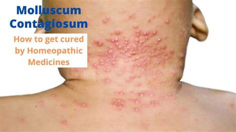 Molluscum Contagiosum Symptoms And Cure By Homeopathy