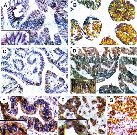 Representative Immunohistochemical Analysis For B Catenin Expression Download Scientific