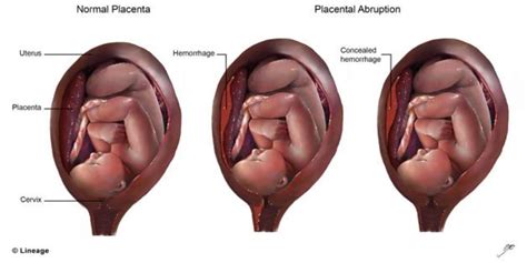 Abruptio Placentae Types