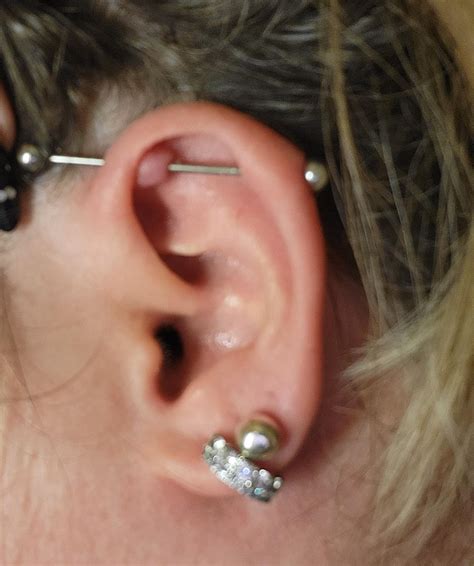 Industrial Piercing Is This A Keloid Or Bump Rpiercingadvice