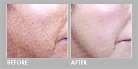 Up To 42 Off Pico Laser Flawless Glowing Skin Premier Clinic