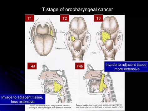 Head And Neck Squamous Cell Carcinoma | PPT