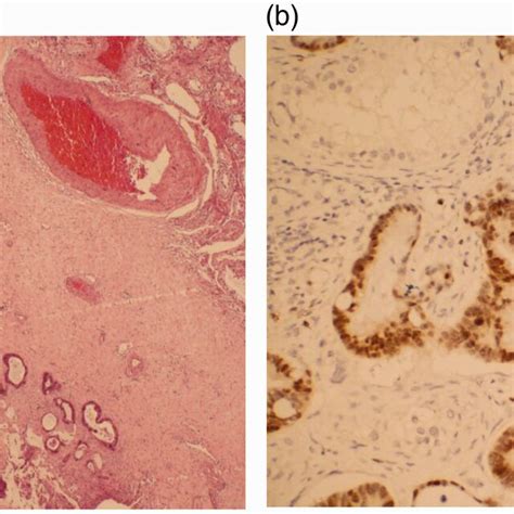 Hematoxylin Eosin Staining And Immunohistochemistry Of The Specimen