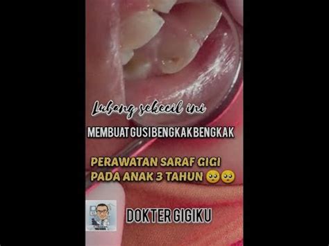 Perawatan Saraf Gigi Anak Yang Berlubang Besar Dan Sering Sakit YouTube