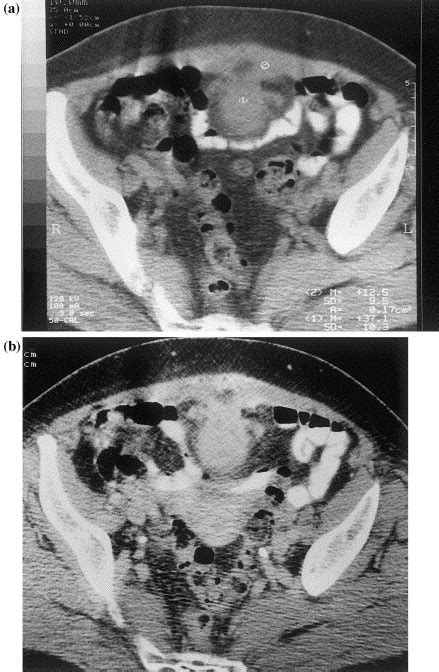 Amebic Abscess Of Urachal Remnants European Journal Of Radiology