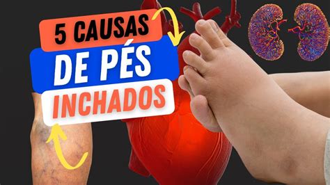 5 Causas De Pés Inchados Youtube 302