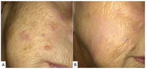 Simultaneous Skin Rejuvenation In Patients Undergoing Medical Treatment For Actinic Keratosis