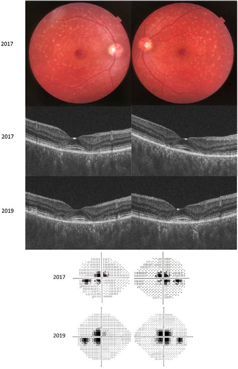 Retinograms Performed At Diagnosis Showed Flecks In The Posterior Pole Download Scientific