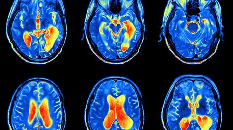 What Are The Causes Of Stage 4 Terminal Brain Cancer? | Our Deer