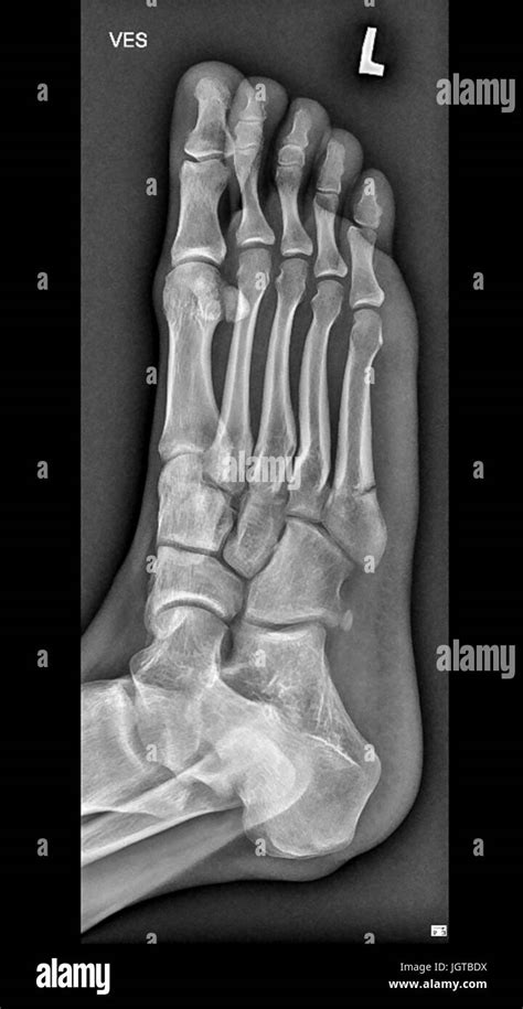 Foot Medical Xray, broken bone, Patient treatment Stock Photo - Alamy