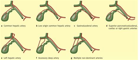 Laparoscopic Cholecystectomy Anatomy