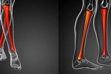 Limb Lengthening | Soraca Medical