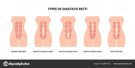 Types Diastasis Recti Also Known Abdominal Separation Common Pregnant