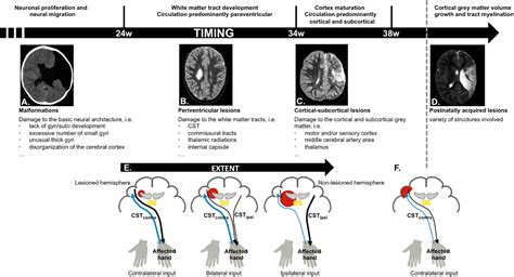 Frontiers The Corticospinal Tract A Biomarker To Categorize Upper