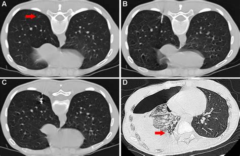 A The location of the ground glass nodule (red arrow) in prone ...