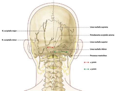 Complications Of Occipital Nerve Block And Radiofrequency Lesioning Anesthesia Key