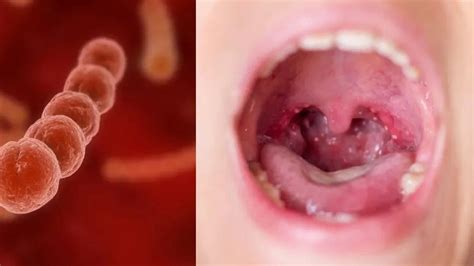 Strep A Bakterisi Nedir A Grubu Streptokok Strep A Bakterisi Nas L Ge Er