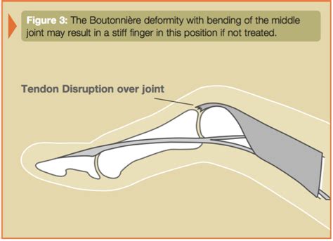 Primary Tendon Repair of the Thumb Extensor (Each, Extensor Tendon Injury) | Lonestar Surgery Center