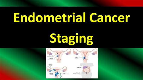 Endometrial Cancer Staging