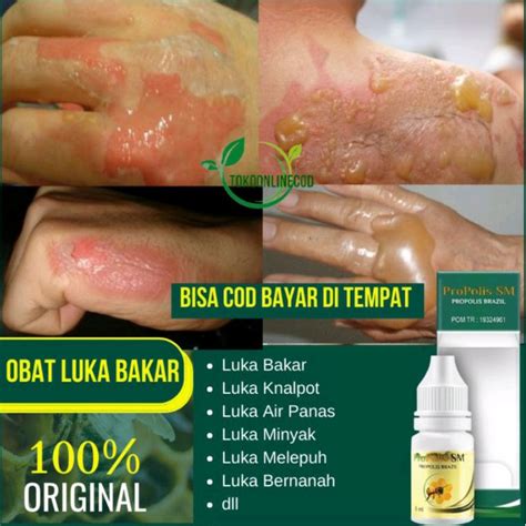 Jual Obat Luka Bakar Obat Luka Kenalpot Alami Obat Bekas Luka Air