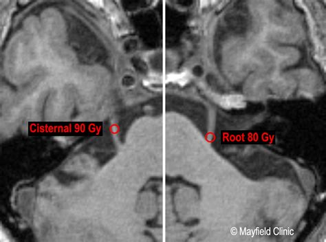 Q&A: Gamma Knife radiosurgery as a treatment for trigeminal neuralgia ...