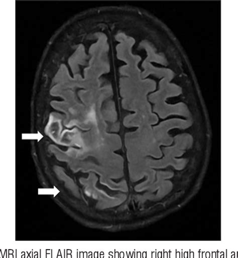 Figure 1 From Understanding Eyelid Closure Apraxia In Right Frontoparietal Stroke Semantic Scholar