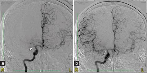 Surgical Neurology International