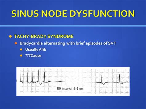 Icd Code For Sinus Node Dysfunction