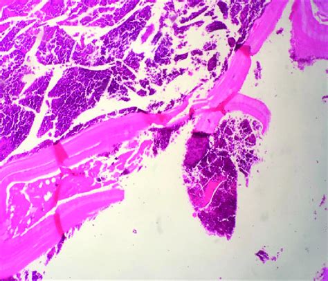 Histopathology Image Of The Hydatid Cyst Wall Consisting Of An Download Scientific Diagram