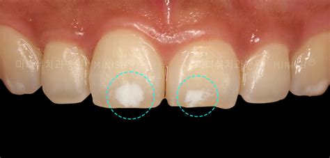 What Are The White Spots On My Teeth