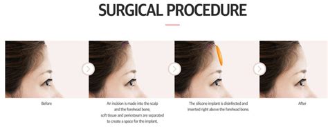 Can a flat forehead be fixed through plastic surgery?Medisetter