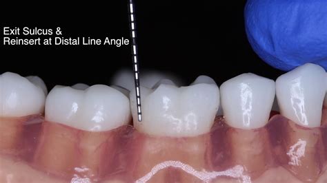 Periodontal Probe Basic Technique Youtube