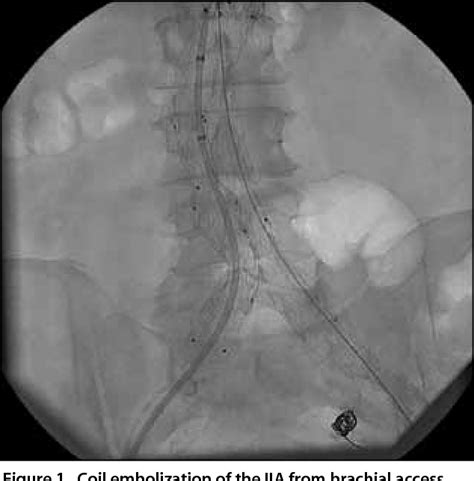 Figure 1 From Endovascular Management Of Common And Internal Iliac