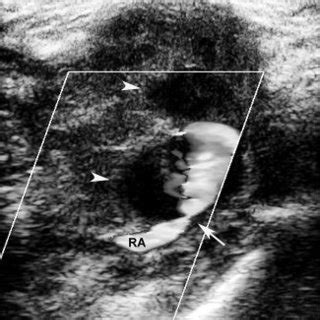 Duplex Ultrasonography Demonstrated Dual Chamber Arrowheads