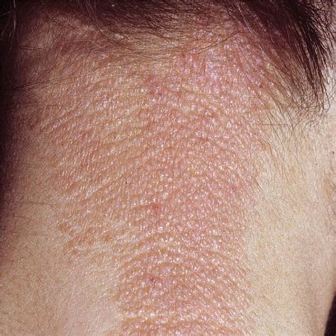 List 91 Pictures Eczema In Groin Area Pictures Stunning