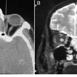 A Non Contrast Axial CT Scan Revealed A Soft Tissue Density Mass