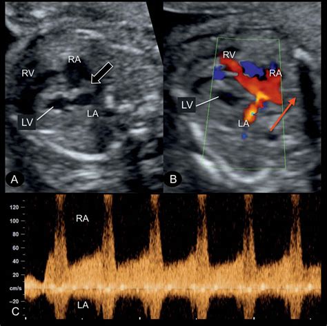 Hypoplastic Left Heart Syndrome And Critical Aortic Stenosis Obgyn Key