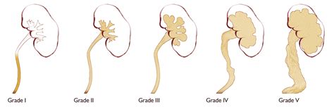 Vesicoureteral Reflux Childrens Hospital Of Orange County