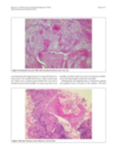 Solution Popliteal Lymph Node Dissection For Metastatic Squamous Cell Carcinoma A Case Report