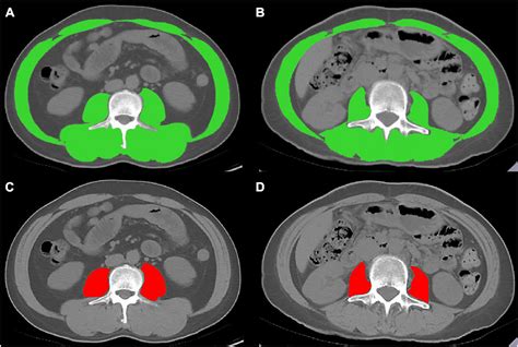 Frontiers Age Specific Reference Values For Low Psoas Muscle Index At