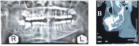 A Panoramic Radiograph Shows Multilocular Lesion On The Right