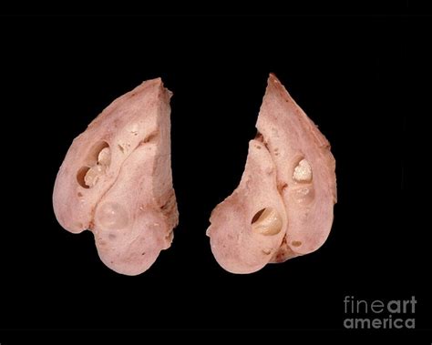 Nabothian Cysts On Cervix Photograph By Jose Calvo Science Photo