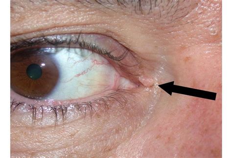 Early Basal Cell Carcinoma Eyelid