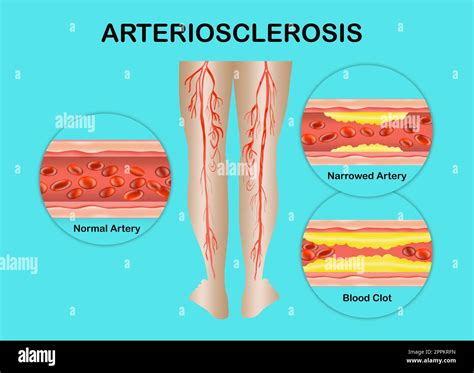 Diagram Showing Angioplasty For Peripheral Artery Disease 46 Off