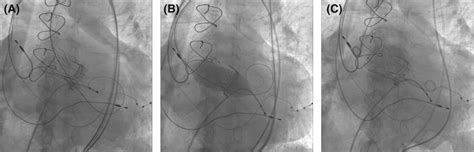 Corevalve Evolut R 29 Mm Implantation The Calcified Valve Leaflets