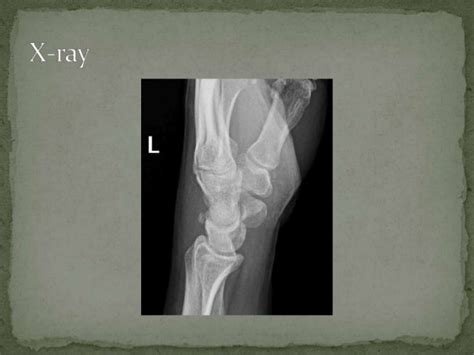 Triquetral Fracture