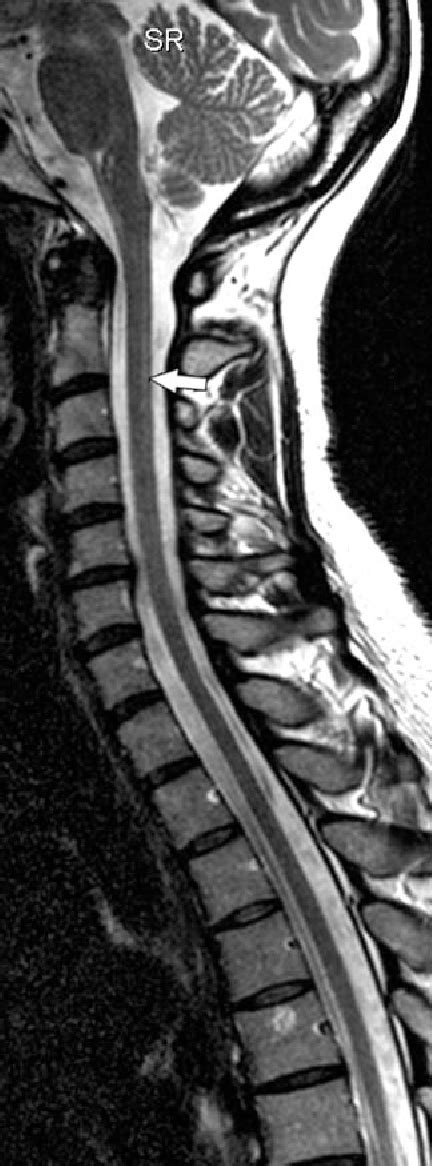 Figure From Mr Imaging Characteristics And Neuropathology Of The